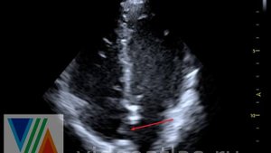 Аневризма МПП