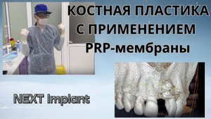 Костная пластика, установка имплантата на верхней челюсти с применением PRP-мембраны.