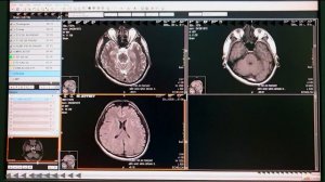 MRI Hitachi 1.5 Tesla Echelon: Actual Planning MRA (Angiogram)