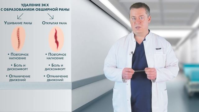 Лазерное лечение кисты копчика (эпителиальный копчиковый ход) ЭКХ
