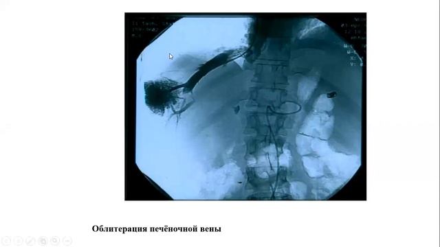 Портальная гипертензия