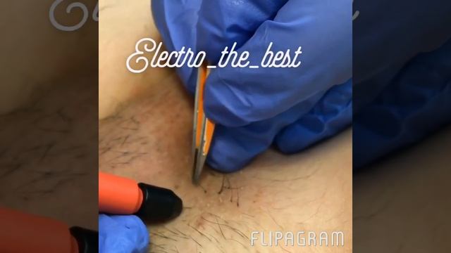 Электроэпиляция г Махачкала смотреть онлайн