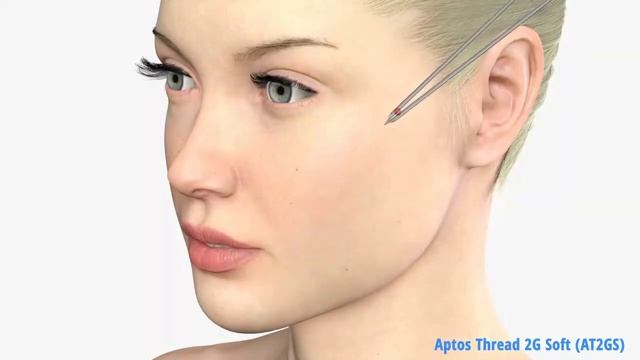 Обучение косметологов методам APTOS | Aptos Thread 2G Soft смотреть онлайн