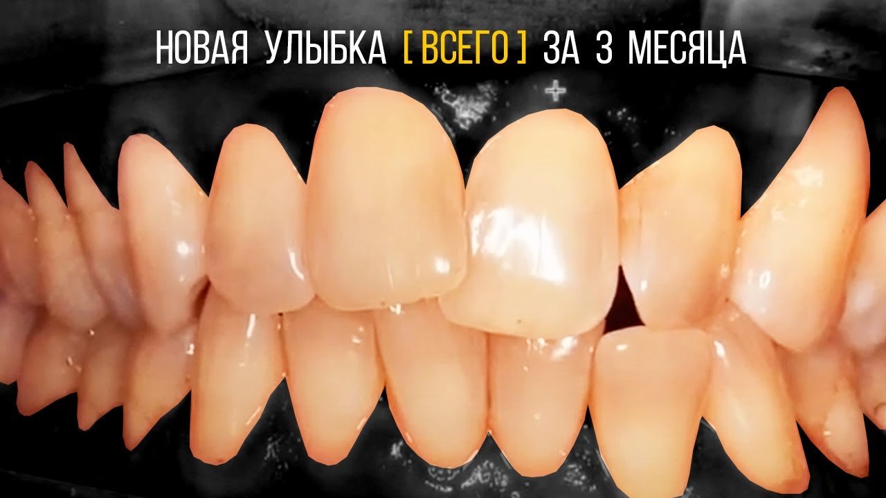 3 месяца [ВСЕГО‼️] на брекетах, и совершенно новая улыбка
