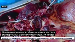 В Иркутском морге показали, что COVID делает с органами человека