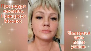 Уколы красоты Четвертый день после процедуры коктейль принцесса Монако/Отзыв