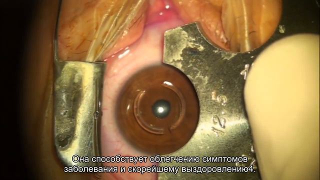 Что вы знаете о синдроме «сухого глаза» и грозит ли он вам? смотреть онлайн