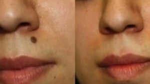 Что означают родинки на теле. Ведические знания