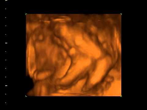 3D УЗИ: младенец в утробе матери смотреть онлайн