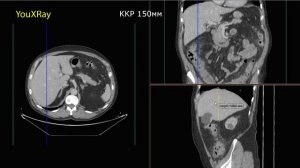 Как измерить размеры печени на КТ?