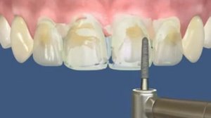 Люминиры. Установка люминиров в Казани