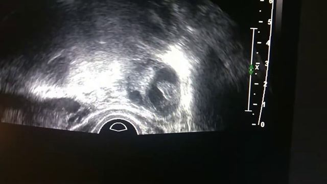 полип эндометрия во 2ю фазу цикла, жёлтое тело. endometrial polyp in the 2nd phase.