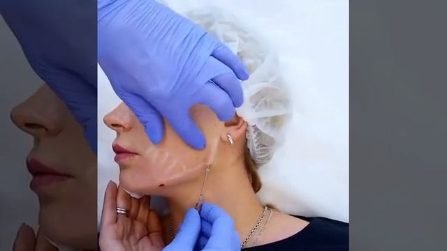 Углы Джоли с нитями Cog 360° смотреть онлайн