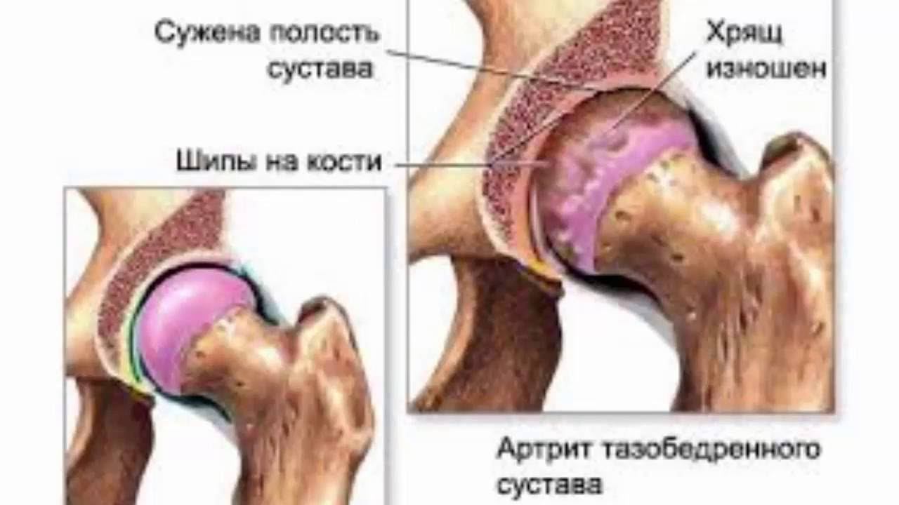 Лечение артроза, лечение артрита традиционной медициной. Артроз коленного сустава.