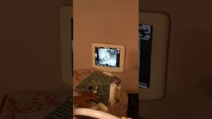УЗИ 10 недель. Беременность двойней. Первый триместр УЗИ. Беременность после ЭКО. SSW 10+4