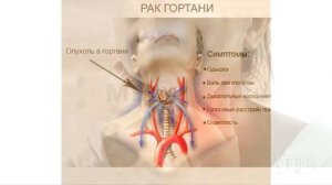 Сухой кашель?//Почему стал хрипеть?//Что со мной???