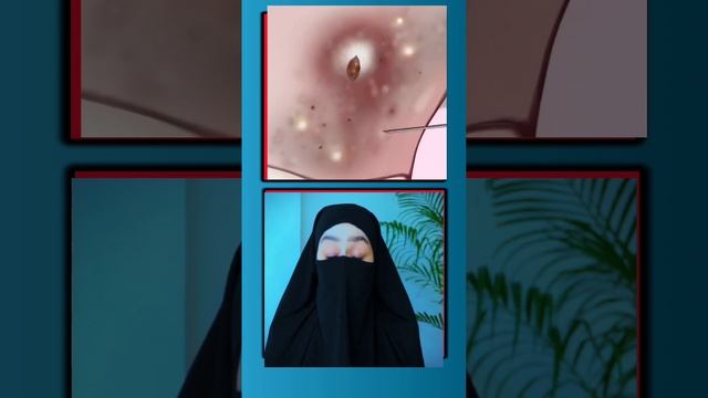 Say Goodbye to Ingrown Hairs: Quick and Effective Tips! EP-8 #ingrownhair смотреть онлайн