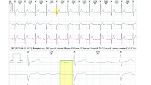 АВ-блокады 1 степени