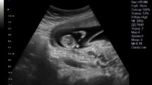 Двойняшки 12 нед