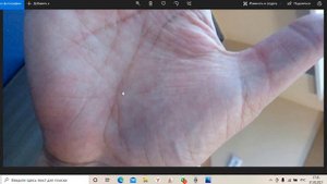 Как выглядит онкология на руках