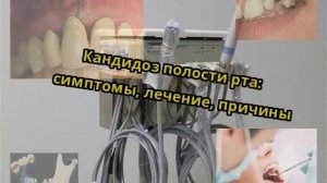 Кандидоз полости рта: симптомы, лечение, причины