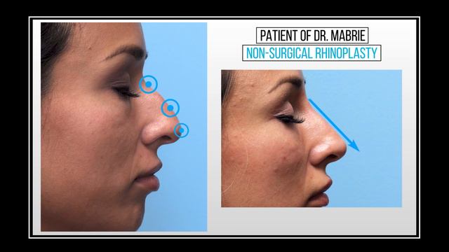 Non Surgical Rhinoplasty: Contouring the Nasal Bridge With Dermal Fillers at Mabrie Facial Institut смотреть онлайн