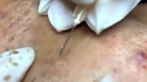 Pimple popping | Cyst popping | Удалить угрей на лице дома Избавиться от угрей дома