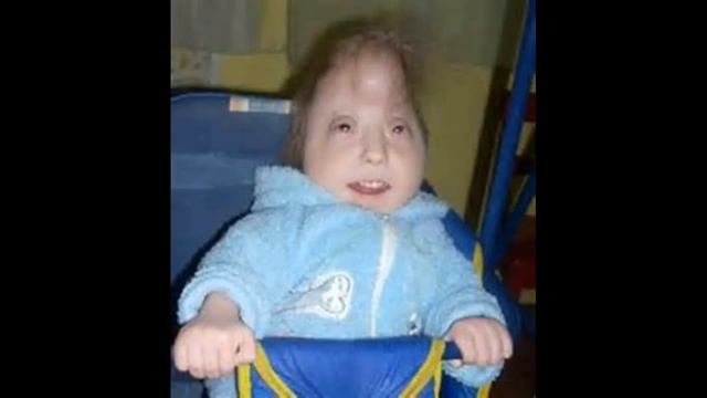 Как лечить и Лечение синдрома Эдвардса