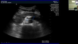 УЗ в диагностике мужского бесплодия Эректильная Дисфункция Болоцков А С