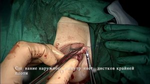 Промежностная гипоспадия. Двухэтапная пластика трасплантатом препуция.