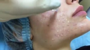 Мезотерапия лица