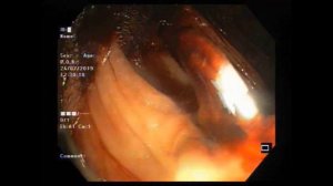 Эндоскопическое клипирование