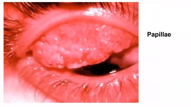 Trachoma by Dr. Pliers Tusingwire смотреть онлайн