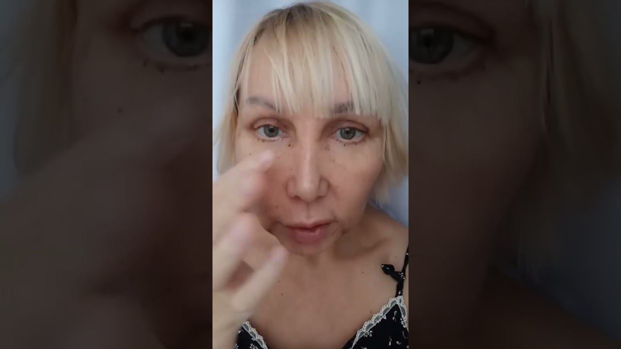 Блефаропластика. Платизмопластика. Результат на десятый день. #эллапанкратова #блефаропластика