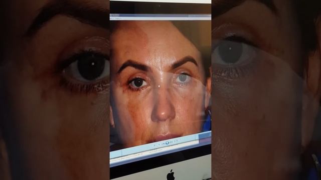 Малярный липолиз и верхняя и нижняя блефаропластика.