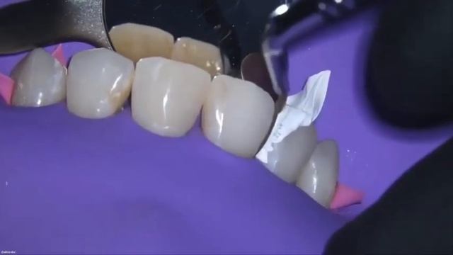 РЕСТАВРАЦИЯ ПЕРЕДНИХ ЗУБОВ?? Front teeth restoration??