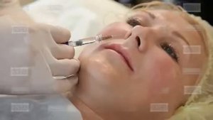 Носогубная складка