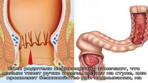 Зуд в заднем проходе у детей