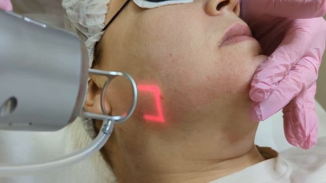 Лазерная шлифовка на фракционном аппарате СО2 Dermaxel