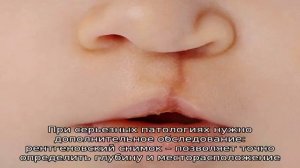 Заячья губа: причины, диагностика, лечение