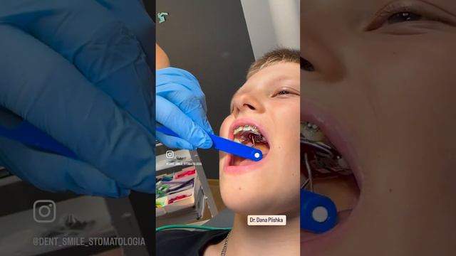 Незнімний апарат для розширення верхньої щелепи. смотреть онлайн