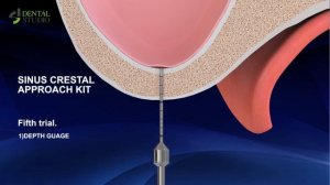 Набор для закрытого синус лифтинга от Dental Studio
