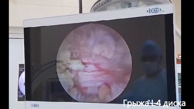 UBE. Грыжа L4 диска. Эндоскопическое удаление. смотреть онлайн