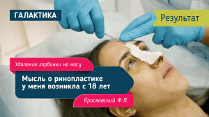 Удаление горбинки на носу - результат | Красковский Федор Янович