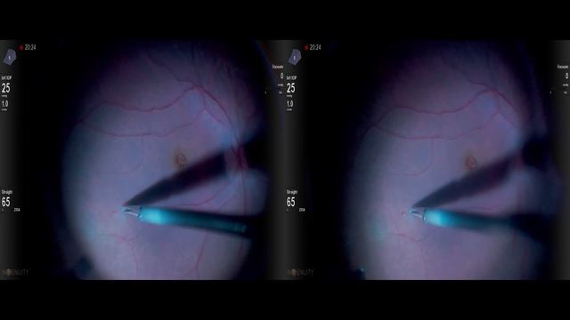 Large FTMH , ILM envelope technique Lukan Mishev live stream смотреть онлайн