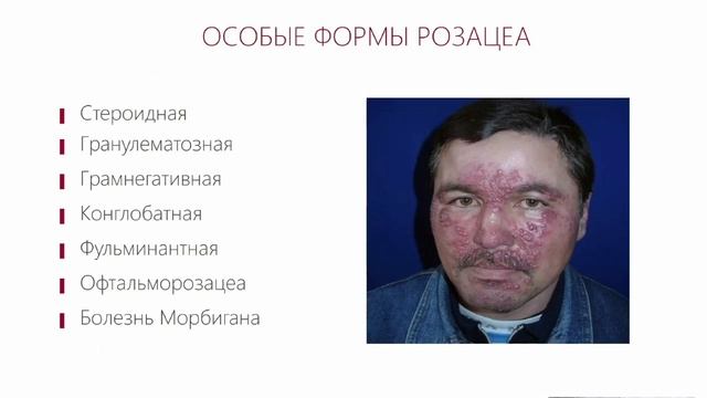 Розацеа: от понимания этиопатогенеза к рациональному лечению и эффективной профилакике.