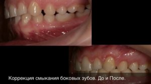 Диастема. Ставить коронки или исправлять на брекетах?