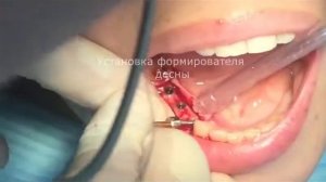 Установка формирователя десны.