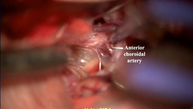 Удаление тератомы головного мозга (18+) смотреть онлайн