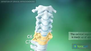 Шейный остеохондроз смотреть онлайн